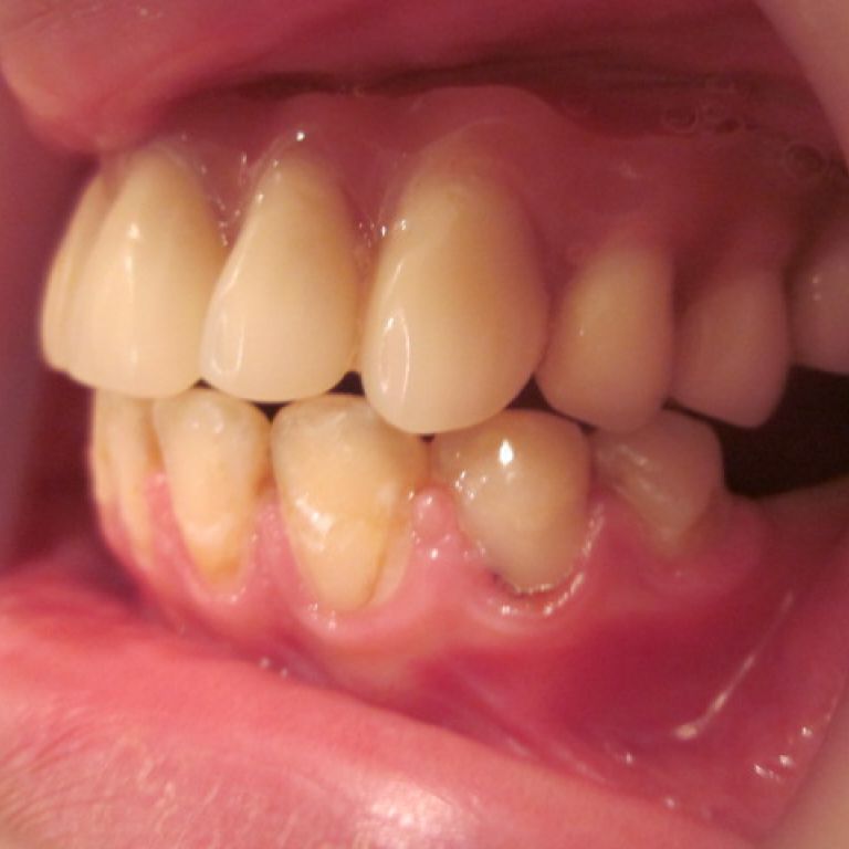 Po leczeniu ortodontyczno-protetyczno-implantologicznym