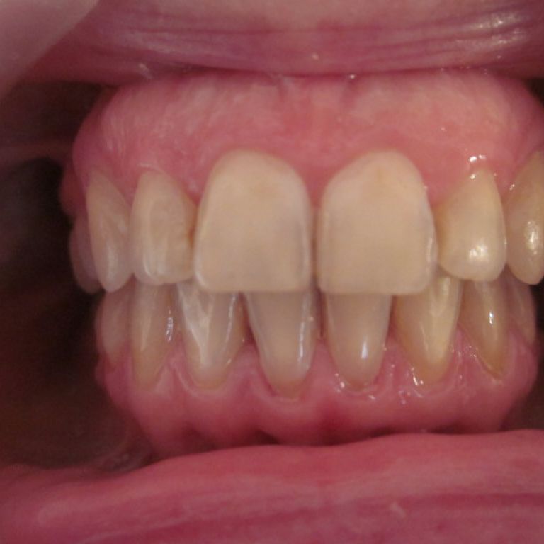 Po leczeniu ortodontycznym